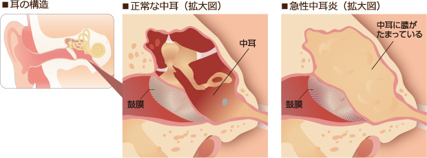 急性中耳炎