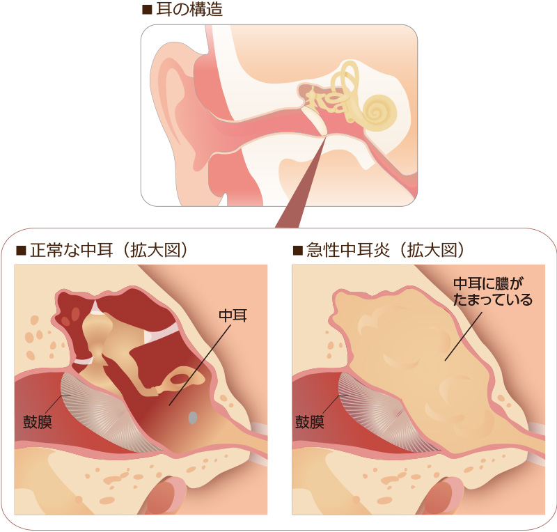 急性中耳炎