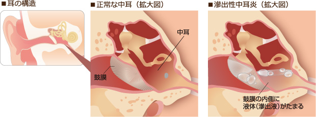 滲出性中耳炎