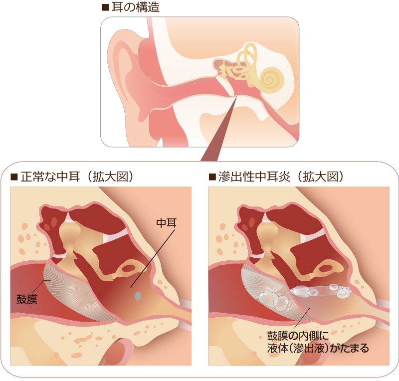 滲出性中耳炎