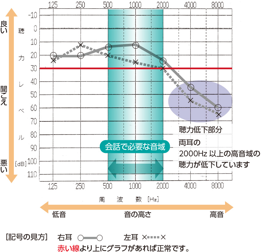 加齢性難聴