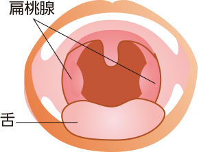 白い 扁桃 腺