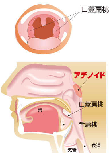 アデノイド肥大