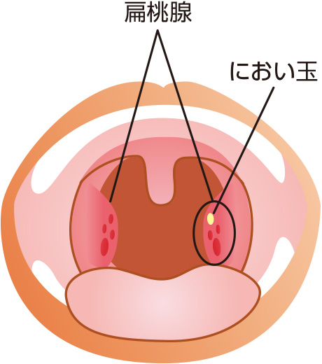 喉 臭い玉